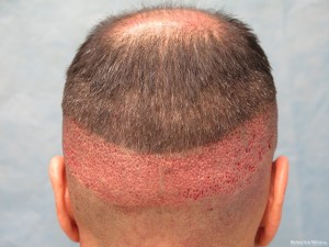 Robotic FUE Hair Transplantation