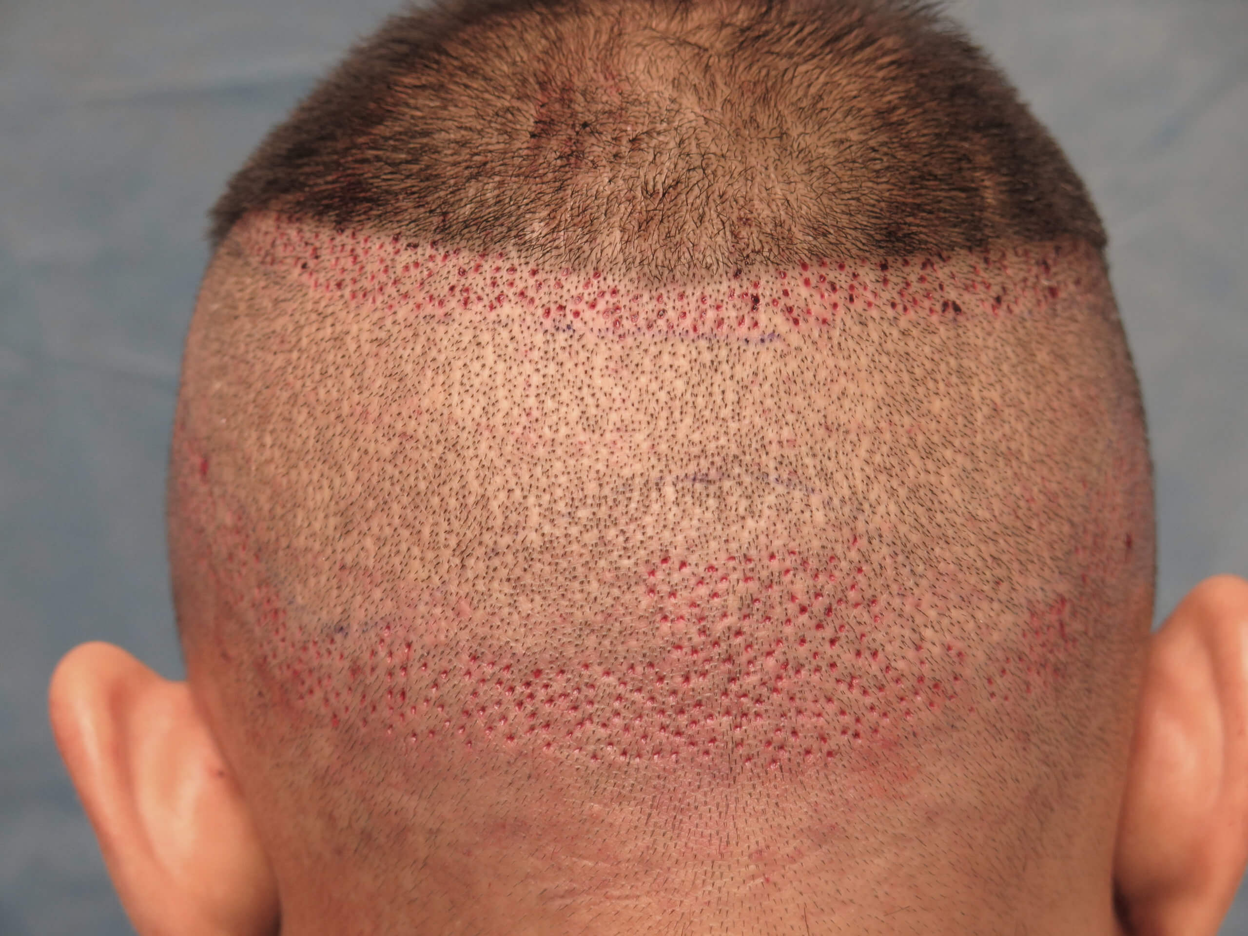 ARTAS Robotic Hair Transplants | Bernstein Medical