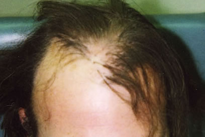 Before Hair Restoration