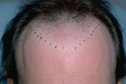 Before Hair Transplant Repair