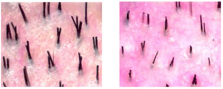 Diagnosis of Hair Loss in Men