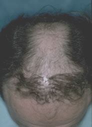 Bad Hair Transplant