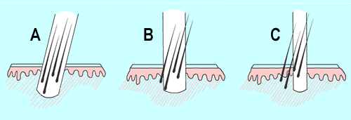 Punch-Graft Technique Illustration