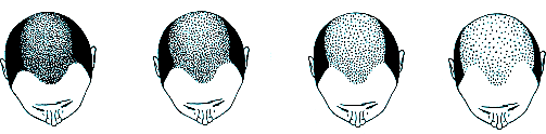 Guide to Hair Restoration - Progression of male hair loss in Diffuse Patterned Alopecia (DPA) and Diffuse Unpatterned Alopecia (DUPA)