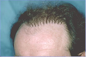 Bad Hair Transplant - Row of Plugs