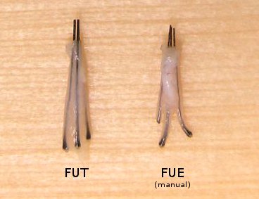 Graft Quality of Manual FUE versus FUT