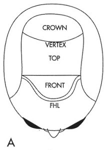 Figure 1a - Bernstein RM, Rassman WR: The Aesthetics of Follicular Transplantation. Dermatol Surg 1997; 23: 785-99.