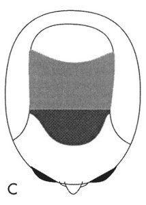 Figure 1c - Bernstein RM, Rassman WR: The Aesthetics of Follicular Transplantation. Dermatol Surg 1997; 23: 785-99.