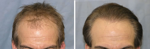 Hair Transplant Before and After