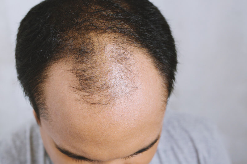 Hairline Balding