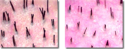 Viewing Miniaturization of Hair Using a Densitometer