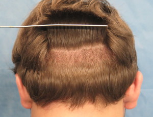 Long-Hair Robotic FUE