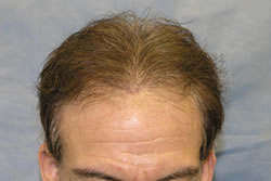 1 Week After 2nd Hair Transplant