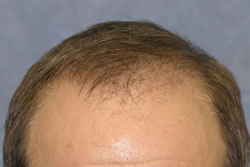 2 Weeks After Hair Transplant