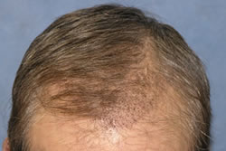 1 Week After Hair Transplant