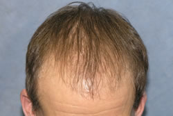 2 Months After Hair Transplantation