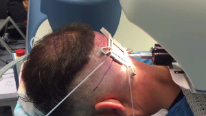 Robotic FUE Donor Harvest