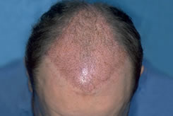 Distribution of Retransplanted grafts