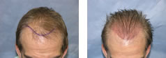 Hair Transplant Photo Journal