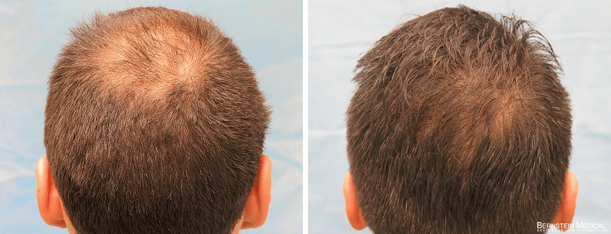 Bernstein Medical - AVQ: Interested in hair transplant procedure specifically for the crown area to address thinning or balding. Before and After Hair Transplant Photo 