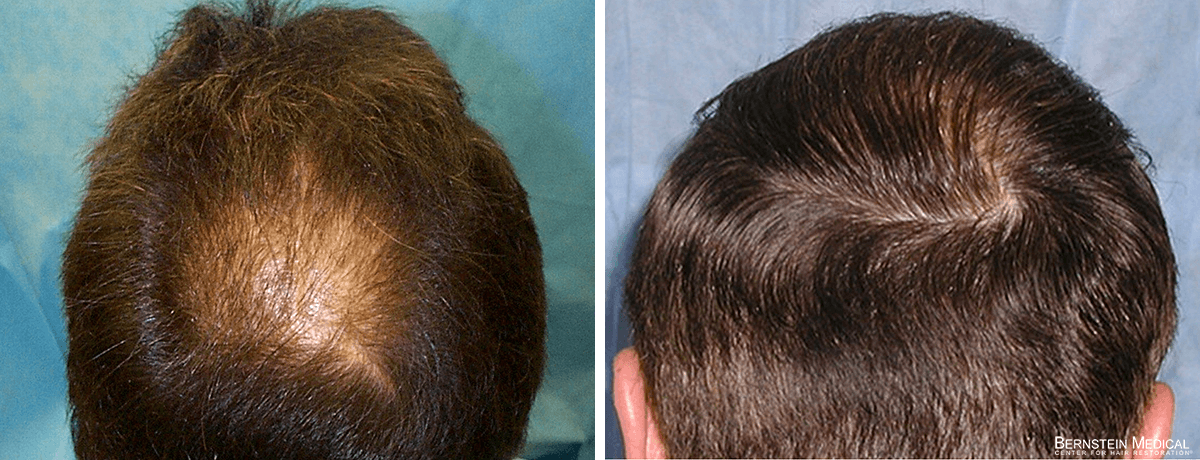 Bernstein Medical - LCI: Candidate looking into crown hair transplant for long-term hair restoration. Before and After Hair Transplant Photo 