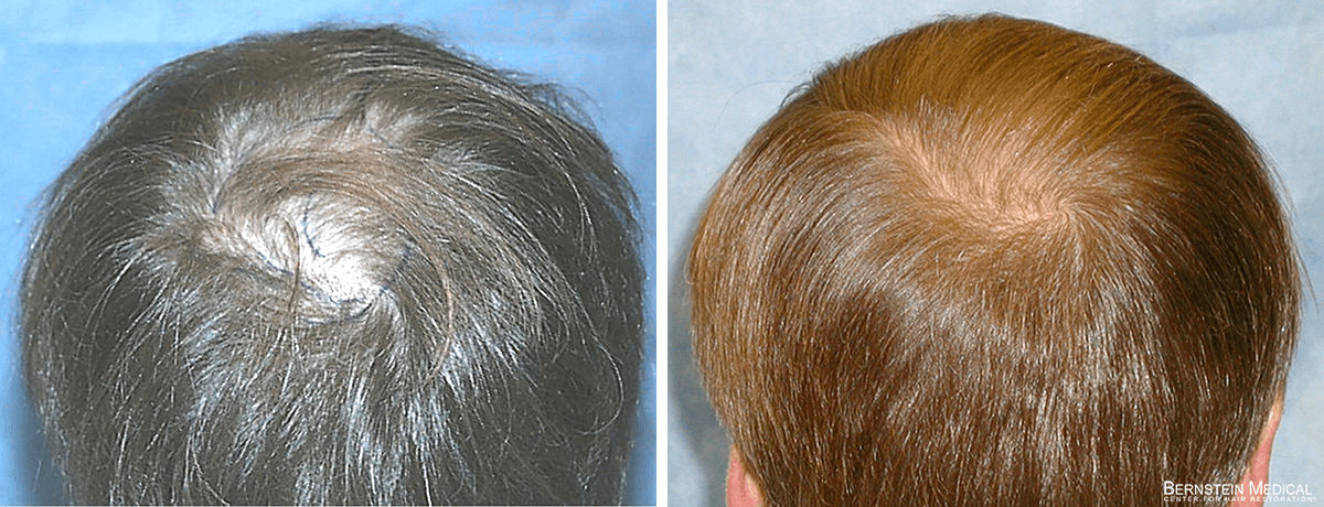 Bernstein Medical - ODR: Exploring options for hair transplant focused on restoring the crown region. Before and After Hair Transplant Photo 