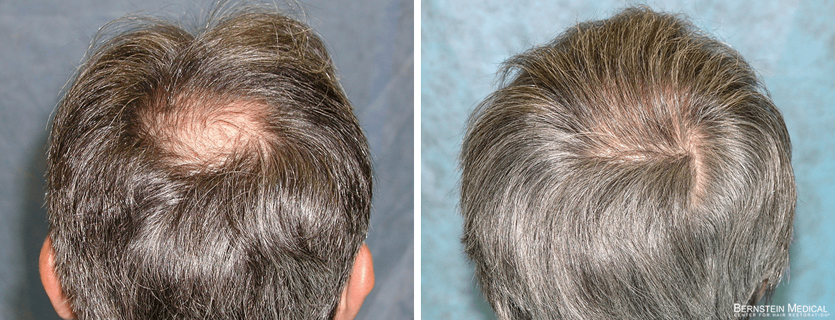 Bernstein Medical - SPI: Considering surgical option to restore hair growth on the crown, aiming for natural-looking results. Before and After Hair Transplant Photo 