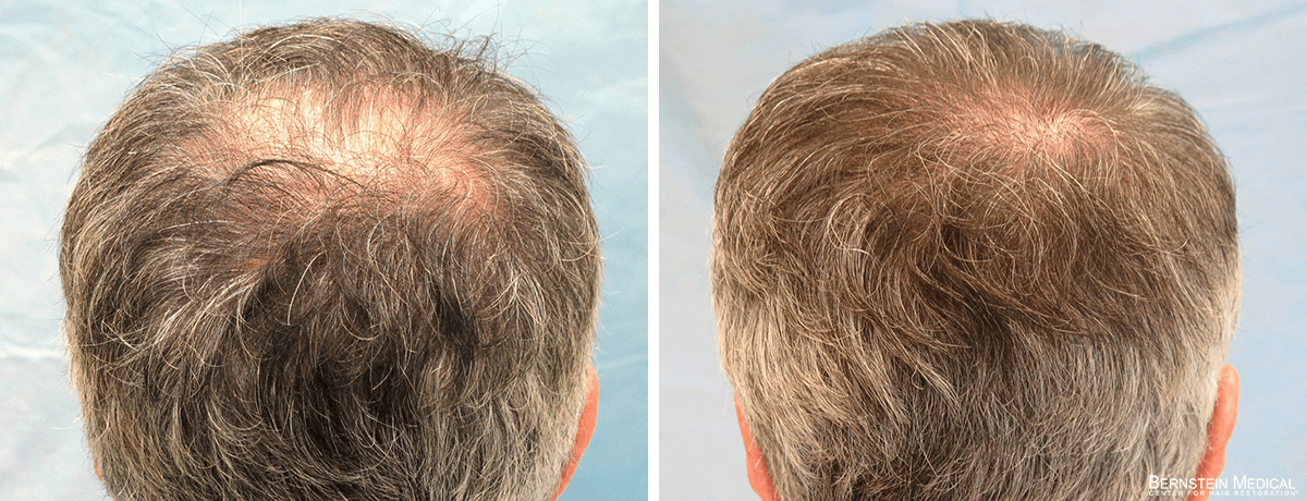 Bernstein Medical - ZIV: Seeking crown hair transplant surgery to achieve fuller hair in the affected area. Before and After Hair Transplant Photo 