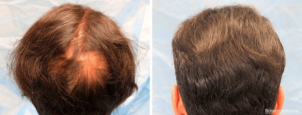 Bernstein Medical - ZNQ: Candidate for crown hair transplant seeking restoration at the top/back of the scalp. Before and After Hair Transplant Photo 