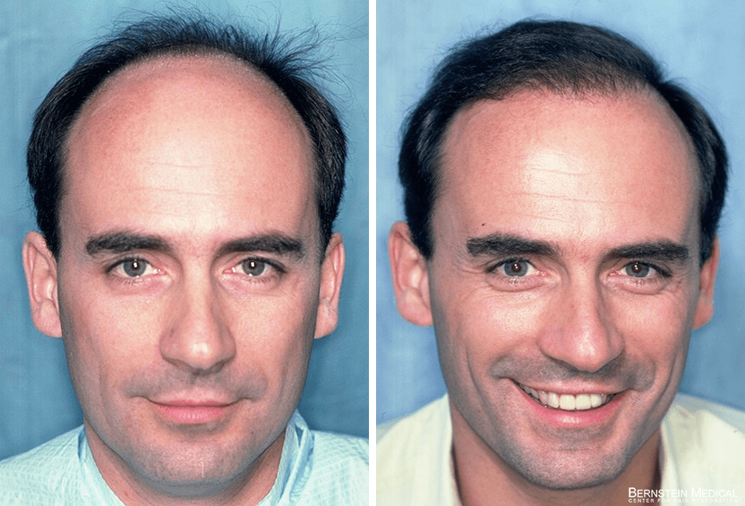 Bernstein Medical - Patient ETC Before and After Hair Transplant Photo 