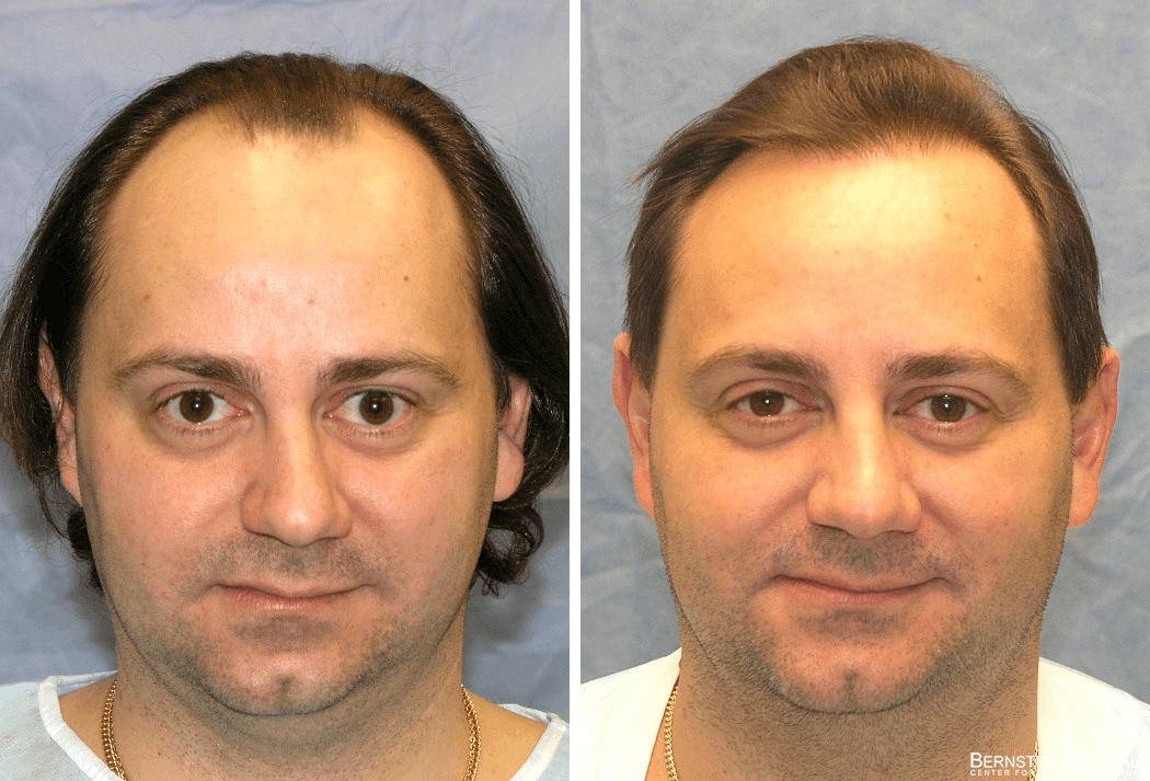 Bernstein Medical - Patient KAF Before and After Hair Transplant Photo 