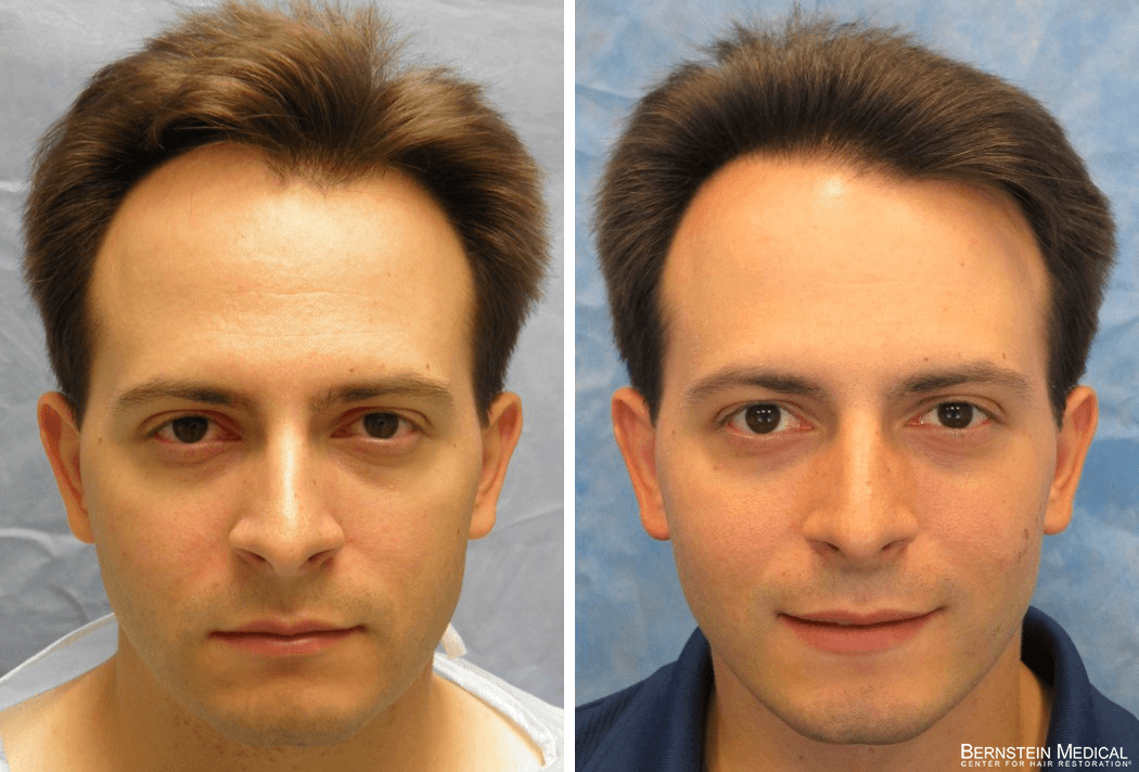 Bernstein Medical - Patient LBI Before and After Hair Transplant Photo 