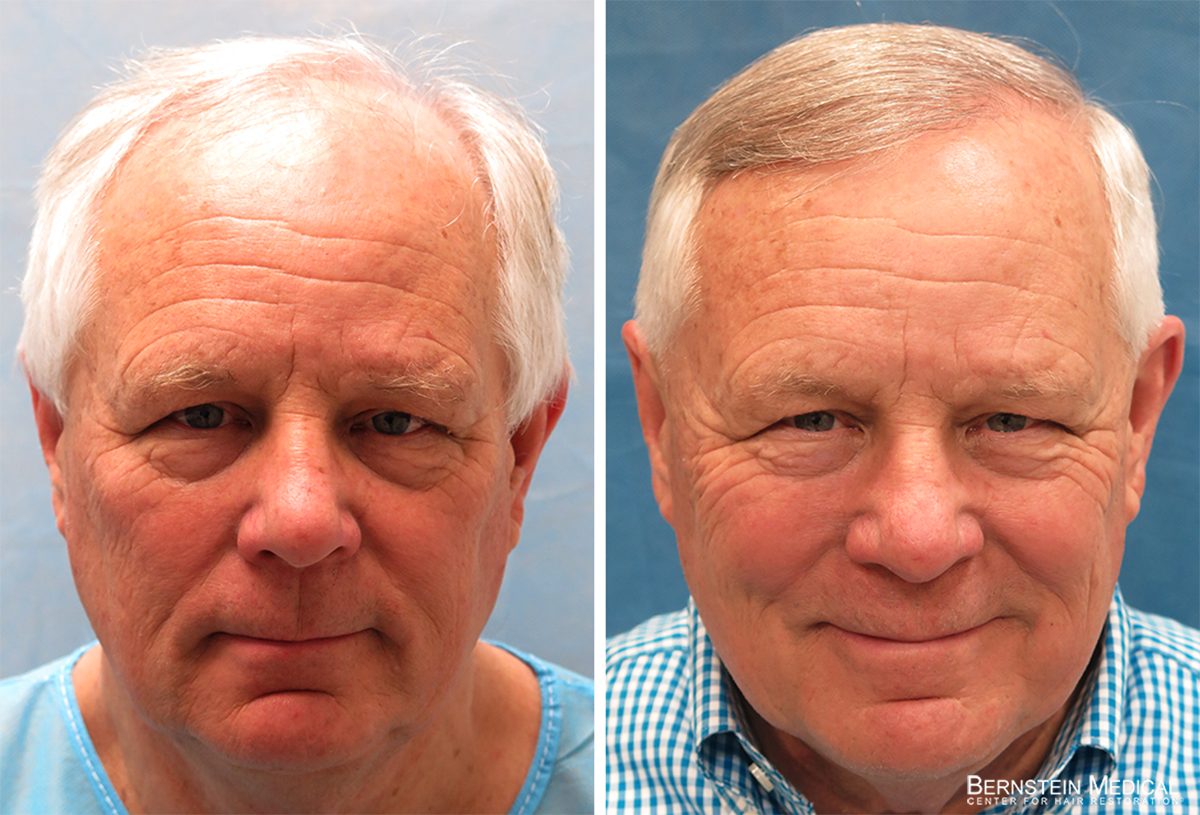 Bernstein Medical - Patient LWC Before and After Hair Transplant Photo 