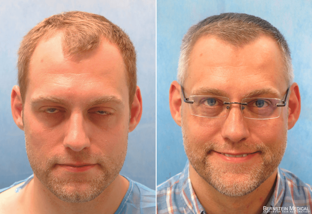 Bernstein Medical - Patient MXF Before and After Hair Transplant Photo 