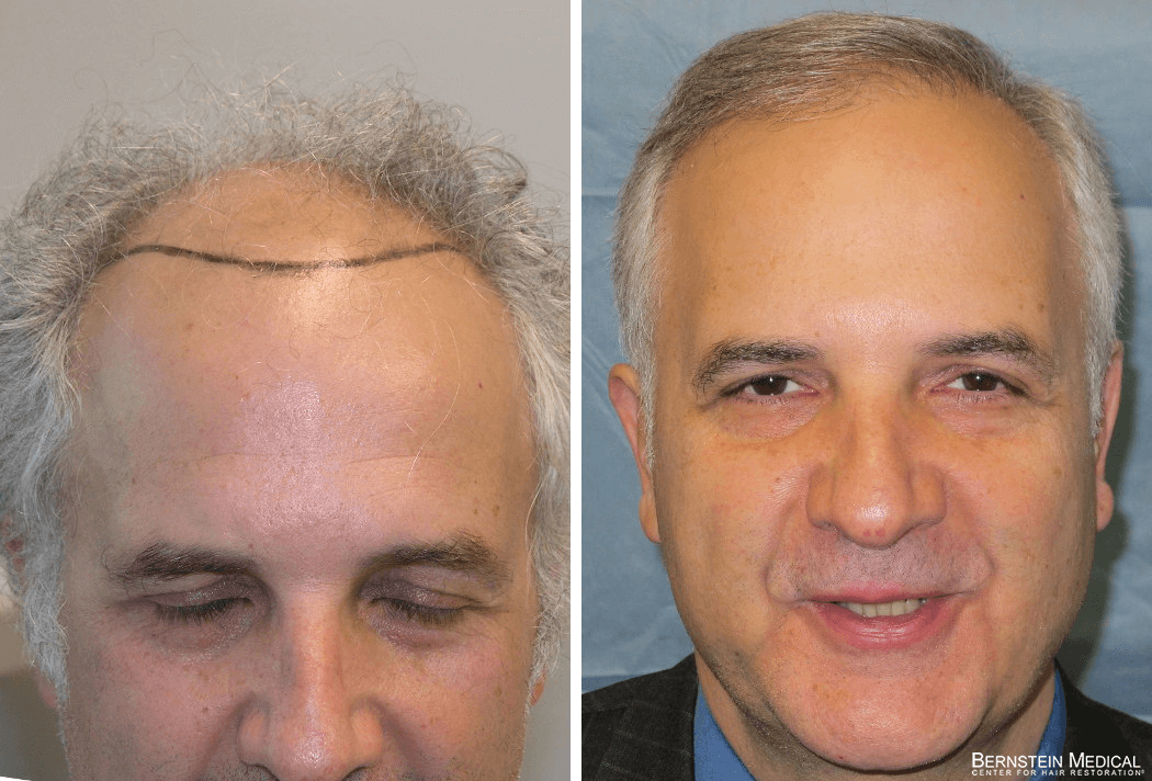 Bernstein Medical - Patient QYI Before and After Hair Transplant Photo 