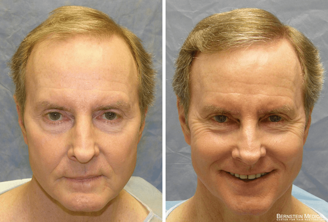 Bernstein Medical - RKS: Interested in surgical solution for crown baldness to improve aesthetic appearance. Before and After Hair Transplant Photo 