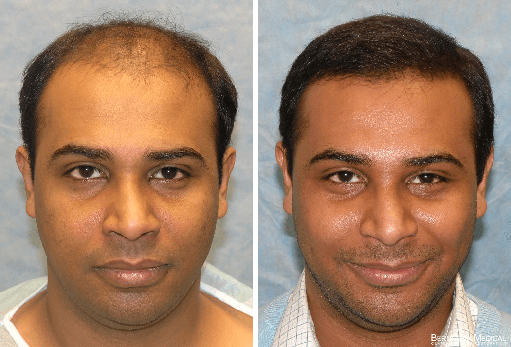 Bernstein Medical - Patient UAR Before and After Hair Transplant Photo 