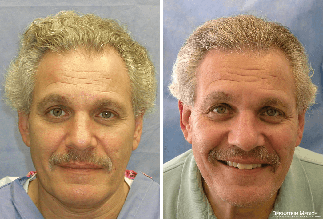 Bernstein Medical - ZLA: Considering hair transplant surgery for the crown to regain hair density. Before and After Hair Transplant Photo 