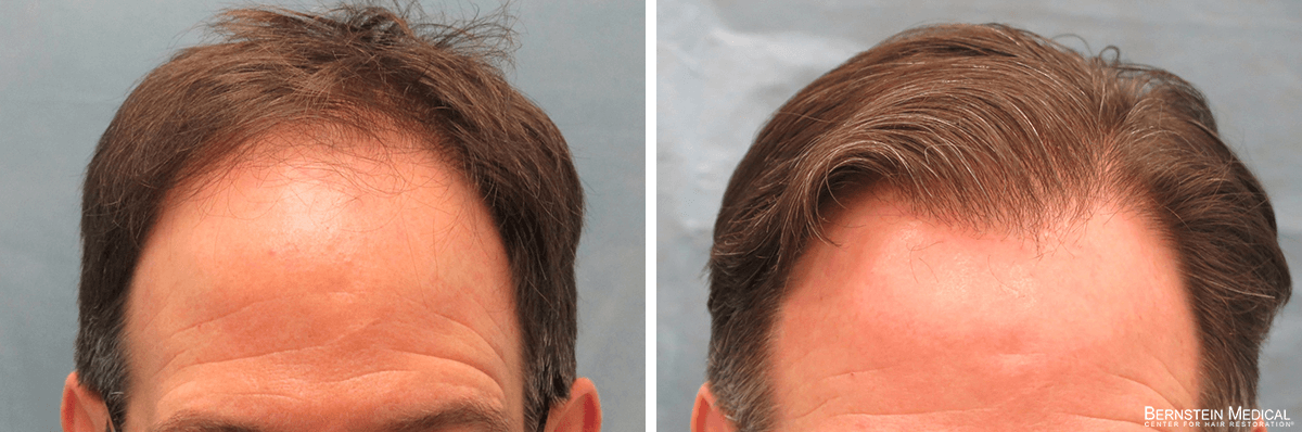 Bernstein Medical - Patient ERL Before and After Hair Transplant Photo 