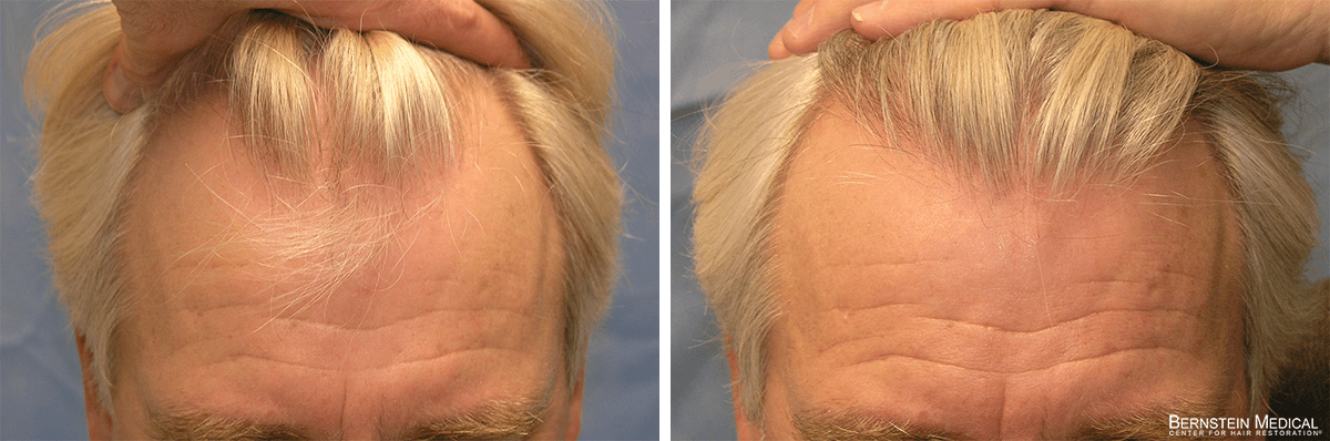 Bernstein Medical - Patient IOV Before and After Hair Transplant Photo 