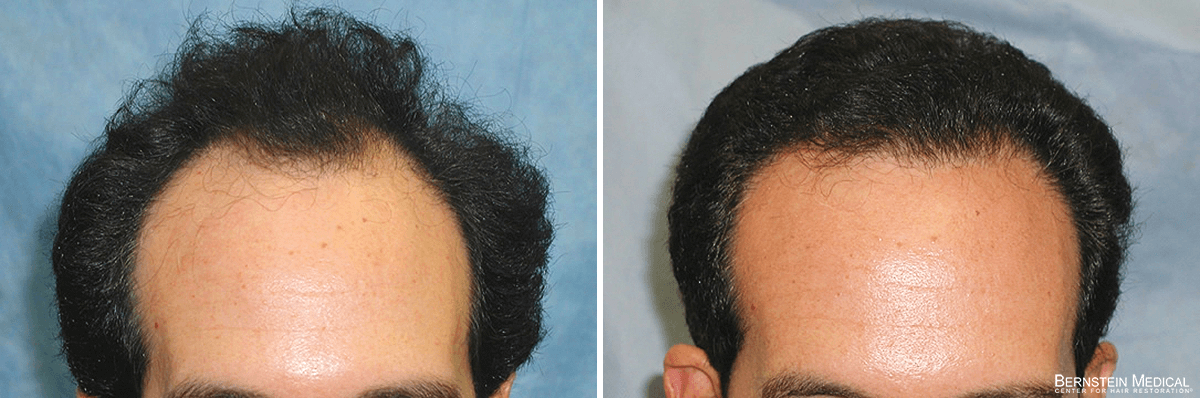 Bernstein Medical - Patient MCL Before and After Hair Transplant Photo 