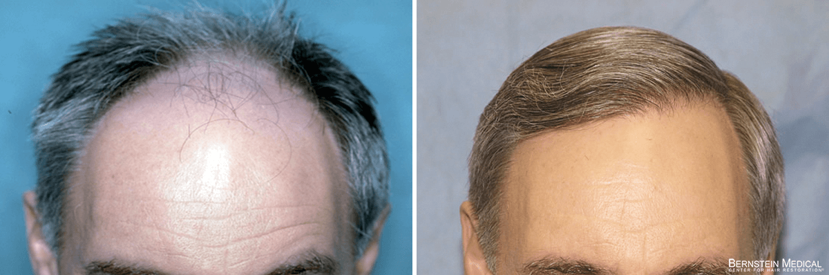 Bernstein Medical - Patient MDA Before and After Hair Transplant Photo 