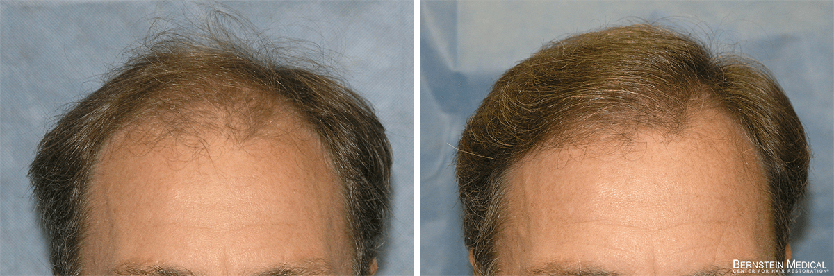 Bernstein Medical - Patient QAE Before and After Hair Transplant Photo 