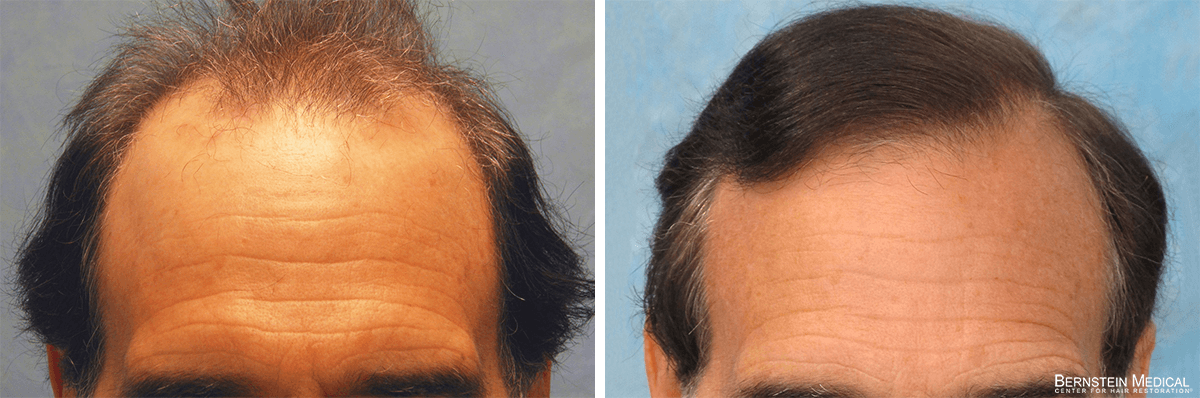 Bernstein Medical - Patient RES Before and After Hair Transplant Photo 