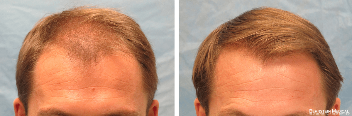 Bernstein Medical - Patient RLZ Before and After Hair Transplant Photo 