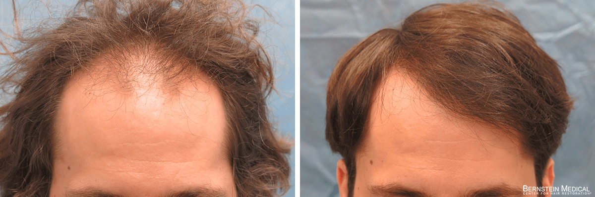 Bernstein Medical - Patient RSI Before and After Hair Transplant Photo 