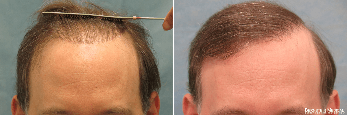 Bernstein Medical - Patient ETI Before and After Hair Transplant Photo 