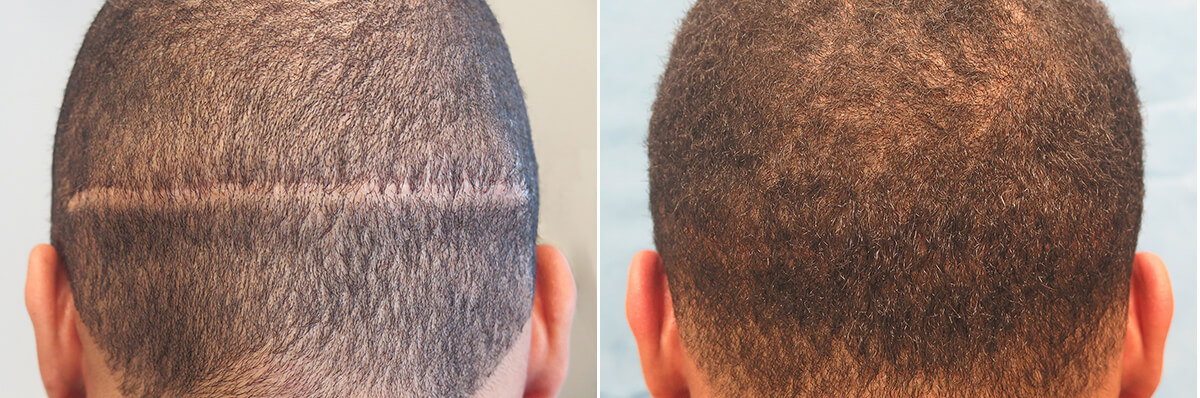 Bernstein Medical - Patient LYQ Before and After Hair Transplant Photo 