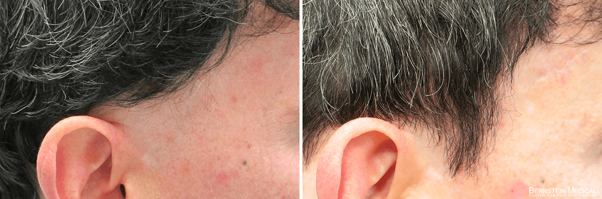 Bernstein Medical - Patient QCL Before and After Hair Transplant Photo 