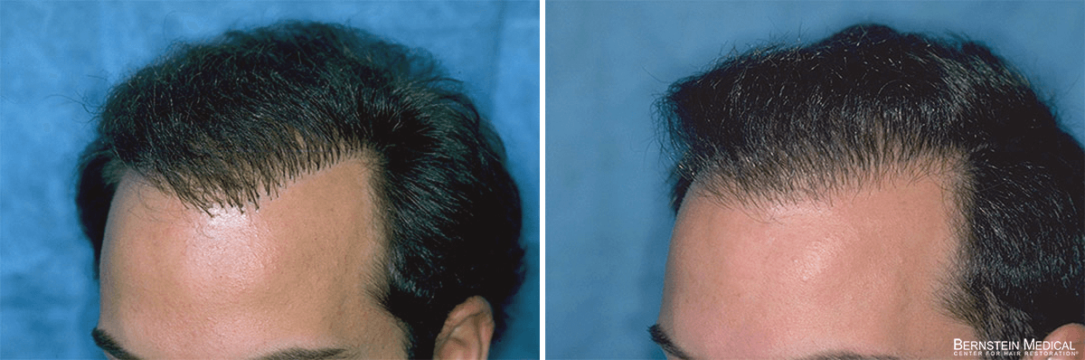 Bernstein Medical - Patient BEI Before and After Hair Transplant Photo 